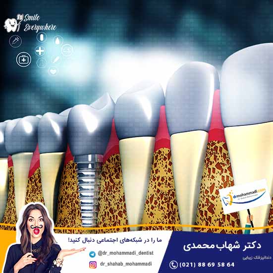 آیا باید بعد از ایمپلنت مسکن مصرف کنیم؟ - کلینیک دندانپزشکی دکتر شهاب محمدی